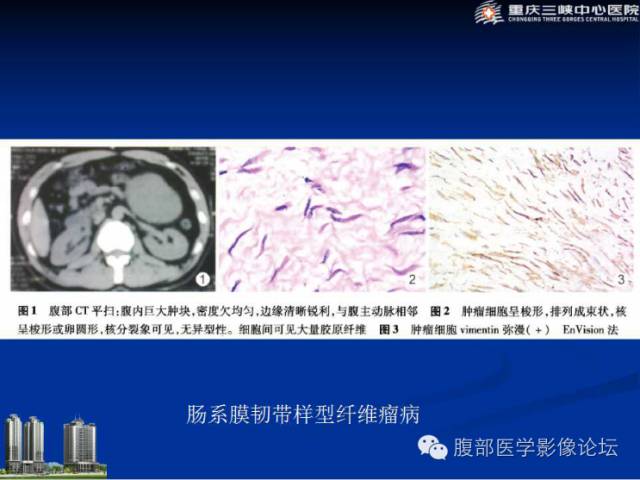 【病例】肠系膜韧带样纤维瘤1例CT影像表现 【病例】肠系膜韧带样纤维瘤1例CT影像表现
