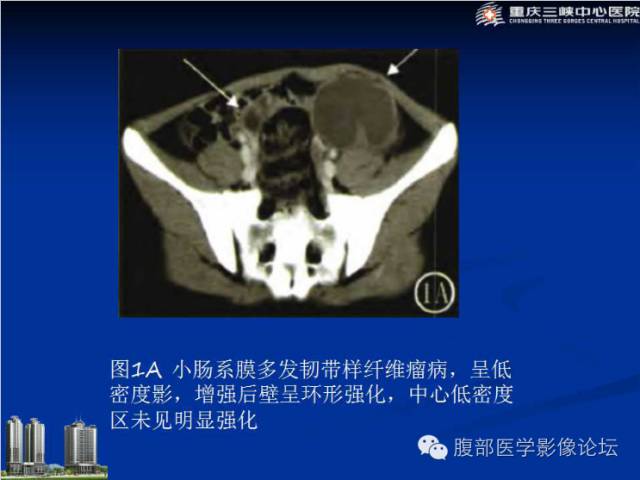 【病例】肠系膜韧带样纤维瘤1例CT影像表现 【病例】肠系膜韧带样纤维瘤1例CT影像表现