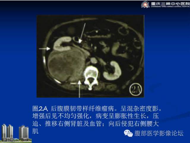 【病例】肠系膜韧带样纤维瘤1例CT影像表现 【病例】肠系膜韧带样纤维瘤1例CT影像表现