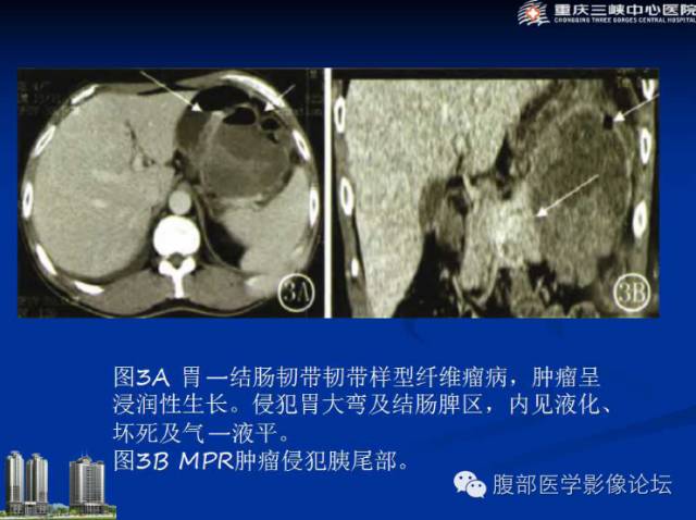 【病例】肠系膜韧带样纤维瘤1例CT影像表现 【病例】肠系膜韧带样纤维瘤1例CT影像表现