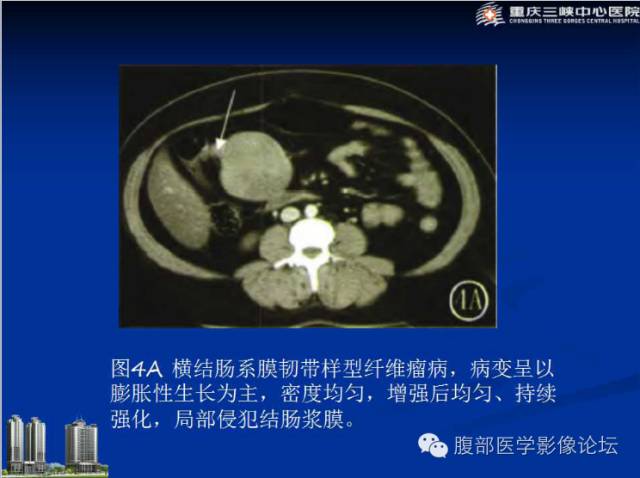 【病例】肠系膜韧带样纤维瘤1例CT影像表现 【病例】肠系膜韧带样纤维瘤1例CT影像表现