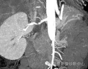 【病例】肾血管肌纤维发育不良一例