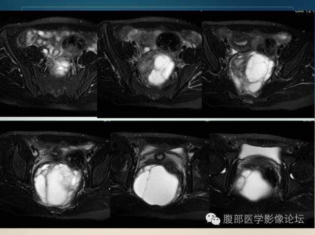 【病例】直肠系膜孤立性纤维瘤伴囊性变1例MR 【病例】直肠系膜孤立性纤维瘤伴囊性变1例MR