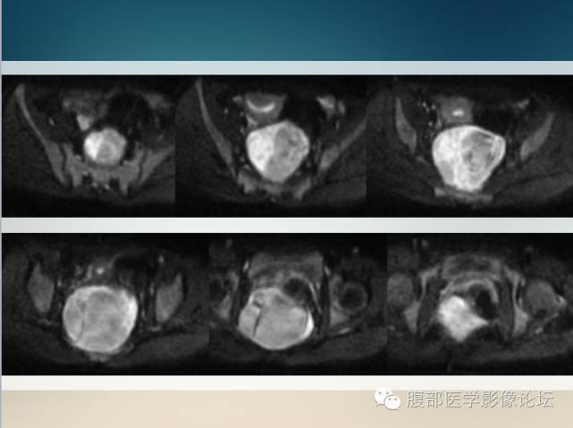 【病例】直肠系膜孤立性纤维瘤伴囊性变1例MR 【病例】直肠系膜孤立性纤维瘤伴囊性变1例MR