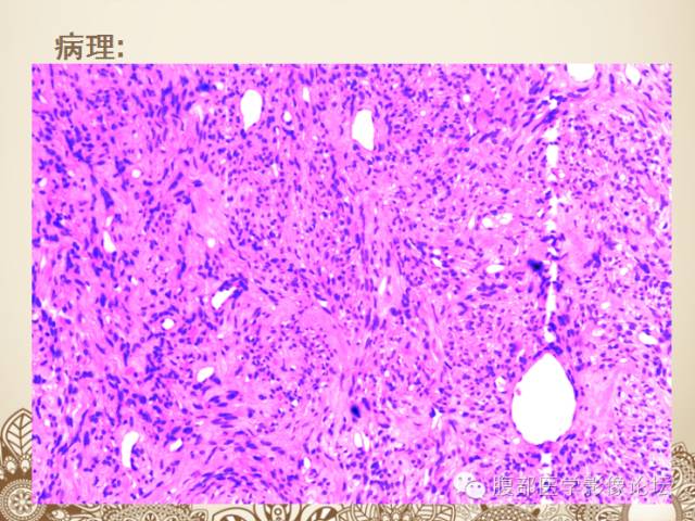 【病例】直肠系膜孤立性纤维瘤伴囊性变1例MR 【病例】直肠系膜孤立性纤维瘤伴囊性变1例MR