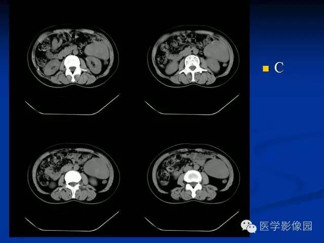 【病例】腹腔炎性肌纤维母细胞瘤1例CT 【病例】腹腔炎性肌纤维母细胞瘤1例CT
