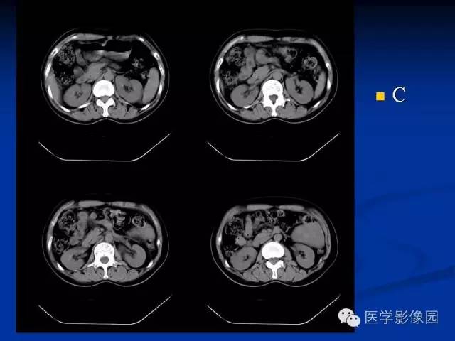 【病例】腹腔炎性肌纤维母细胞瘤1例CT