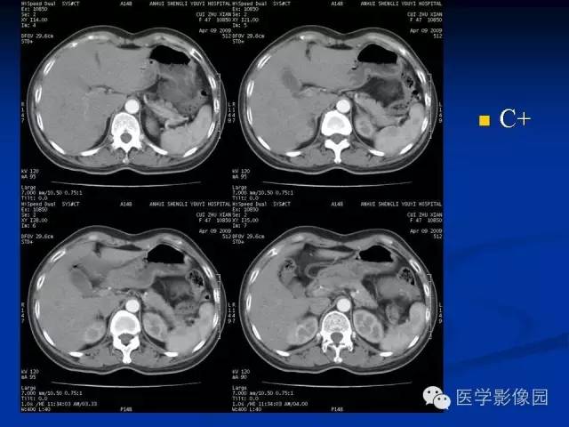 【病例】腹腔炎性肌纤维母细胞瘤1例CT 【病例】腹腔炎性肌纤维母细胞瘤1例CT