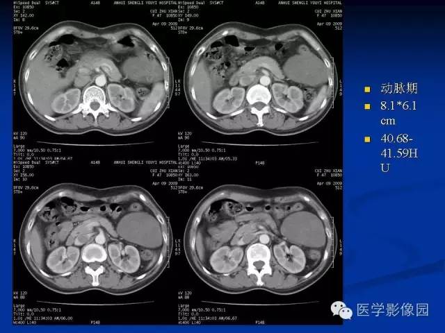 【病例】腹腔炎性肌纤维母细胞瘤1例CT 【病例】腹腔炎性肌纤维母细胞瘤1例CT