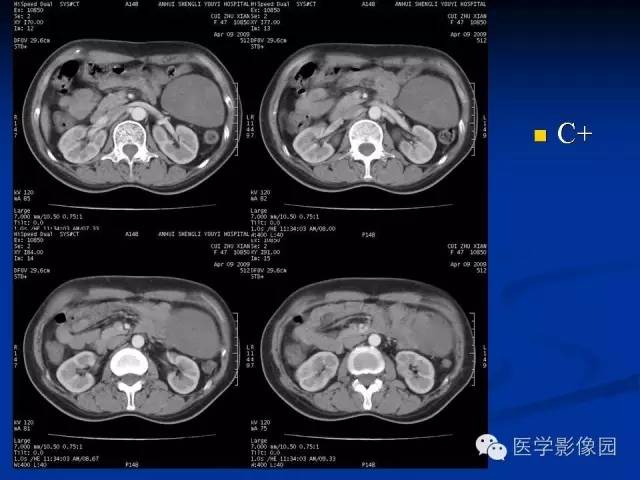 【病例】腹腔炎性肌纤维母细胞瘤1例CT 【病例】腹腔炎性肌纤维母细胞瘤1例CT