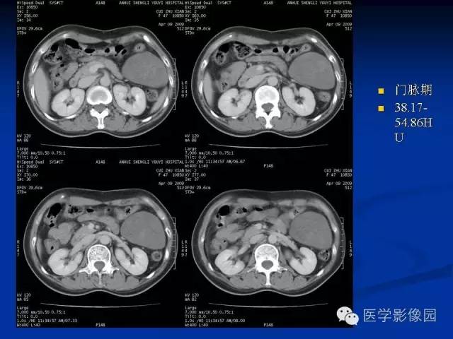 【病例】腹腔炎性肌纤维母细胞瘤1例CT 【病例】腹腔炎性肌纤维母细胞瘤1例CT