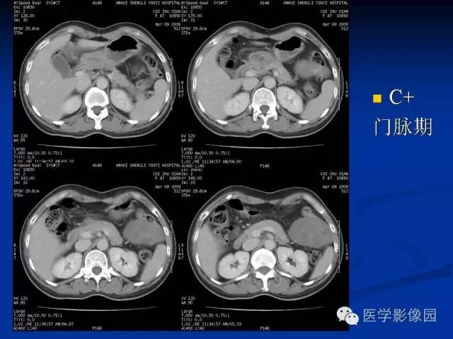 【病例】腹腔炎性肌纤维母细胞瘤1例CT 【病例】腹腔炎性肌纤维母细胞瘤1例CT