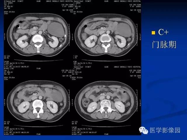 【病例】腹腔炎性肌纤维母细胞瘤1例CT 【病例】腹腔炎性肌纤维母细胞瘤1例CT
