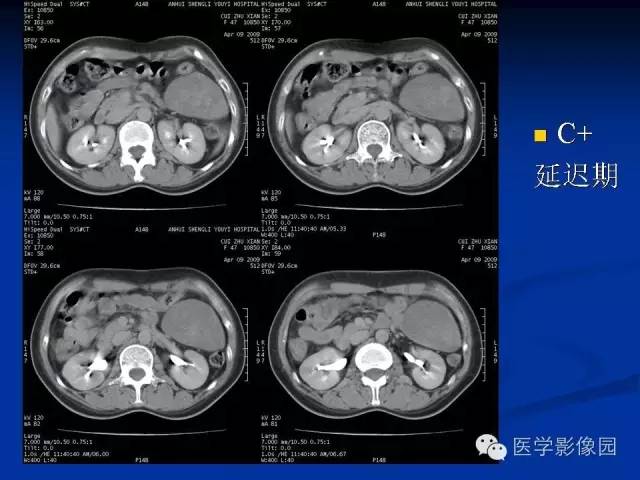 【病例】腹腔炎性肌纤维母细胞瘤1例CT 【病例】腹腔炎性肌纤维母细胞瘤1例CT