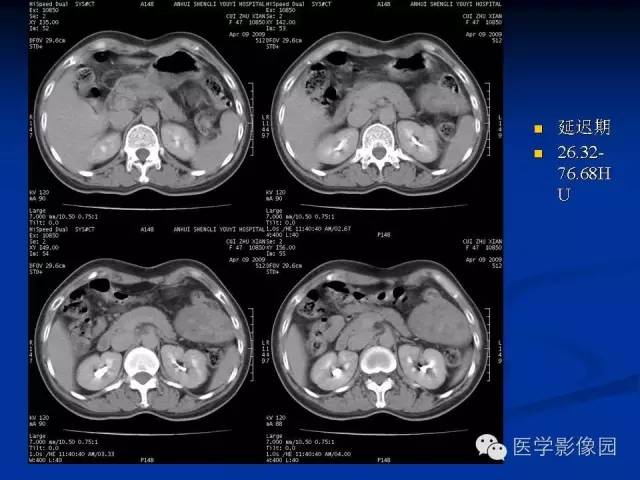 【病例】腹腔炎性肌纤维母细胞瘤1例CT 【病例】腹腔炎性肌纤维母细胞瘤1例CT