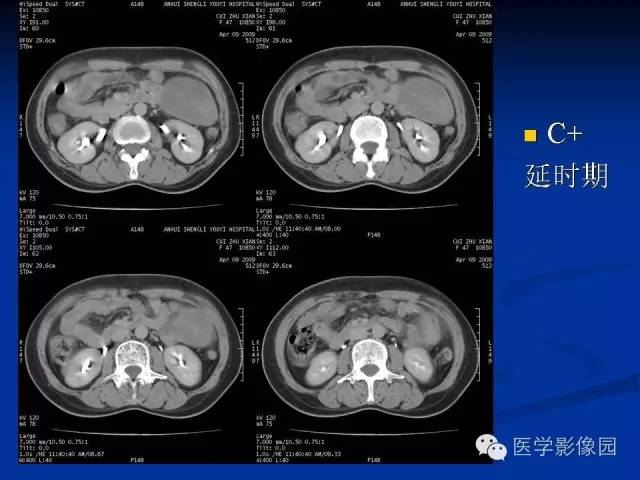 【病例】腹腔炎性肌纤维母细胞瘤1例CT 【病例】腹腔炎性肌纤维母细胞瘤1例CT
