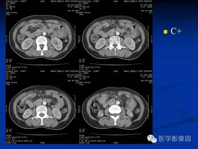 【病例】腹腔炎性肌纤维母细胞瘤1例CT 【病例】腹腔炎性肌纤维母细胞瘤1例CT
