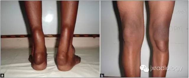 跟腱黄色瘤 Achilles tendon xanthoma 跟腱黄色瘤 Achilles tendon xanthoma