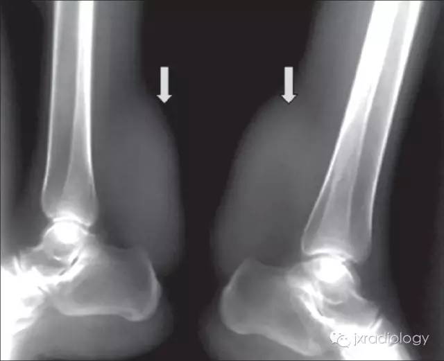 跟腱黄色瘤 Achilles tendon xanthoma 跟腱黄色瘤 Achilles tendon xanthoma