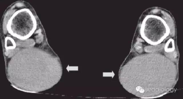 跟腱黄色瘤 Achilles tendon xanthoma 跟腱黄色瘤 Achilles tendon xanthoma
