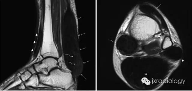 跟腱黄色瘤 Achilles tendon xanthoma 跟腱黄色瘤 Achilles tendon xanthoma