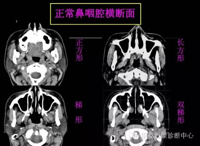 高清鼻咽部CT解剖
