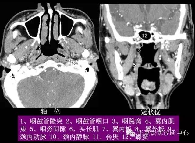 高清鼻咽部CT解剖