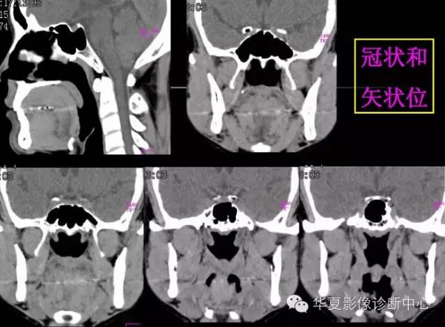 高清鼻咽部CT解剖