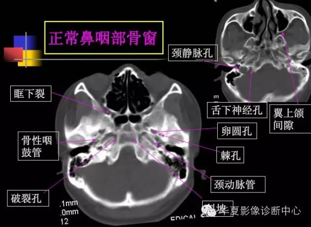高清鼻咽部CT解剖