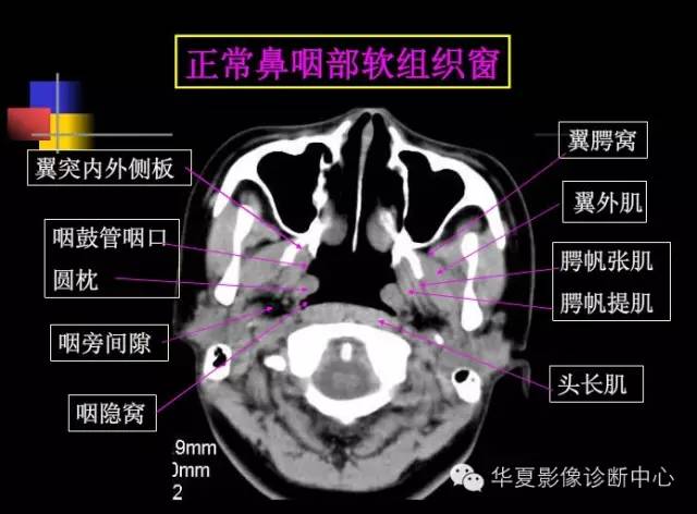 高清鼻咽部CT解剖