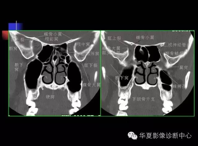 高清鼻咽部CT解剖