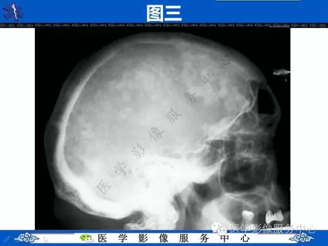 【影像征象】棉絮征