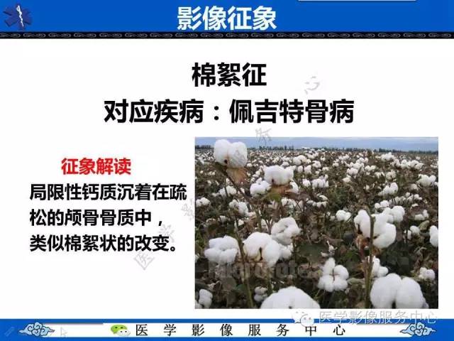 【影像征象】棉絮征