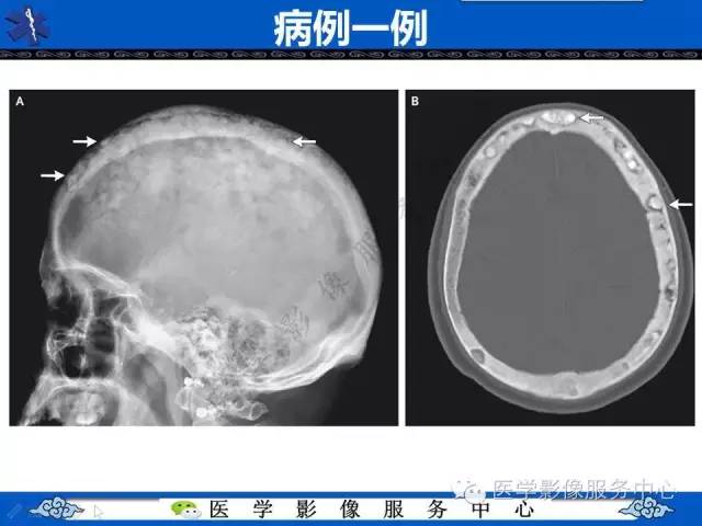 【影像征象】棉絮征