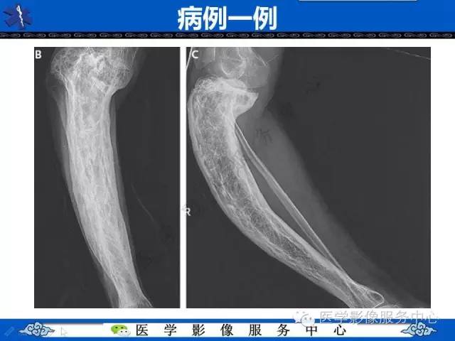 【影像征象】棉絮征