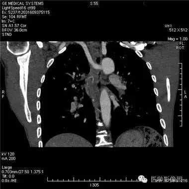 【病例】迷走右锁骨下动脉1例CT影像表现