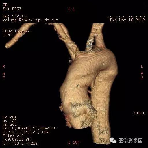 【病例】迷走右锁骨下动脉1例CT影像表现