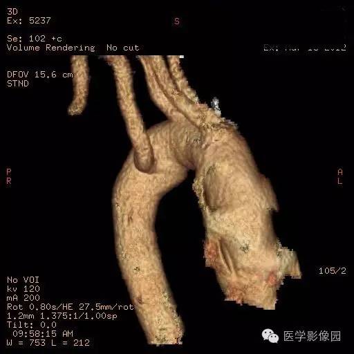 【病例】迷走右锁骨下动脉1例CT影像表现
