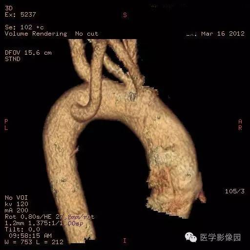 【病例】迷走右锁骨下动脉1例CT影像表现