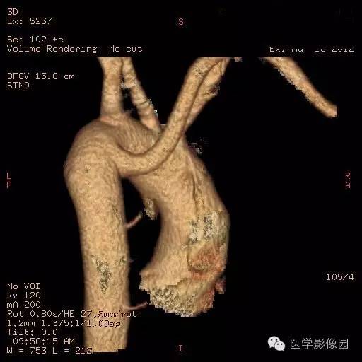 【病例】迷走右锁骨下动脉1例CT影像表现