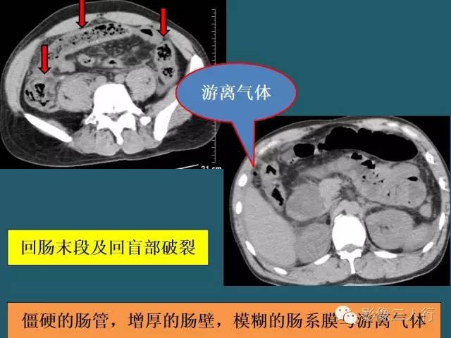 【PPT】肠管与肠系膜损伤的CT诊断