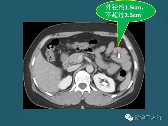 【PPT】肠管与肠系膜损伤的CT诊断