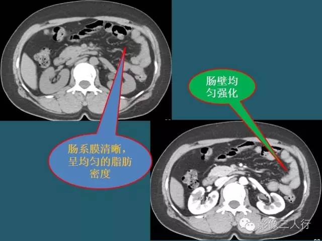 【PPT】肠管与肠系膜损伤的CT诊断