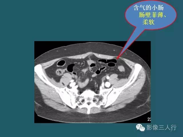 【PPT】肠管与肠系膜损伤的CT诊断