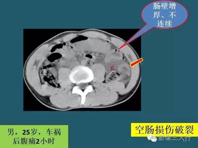 【PPT】肠管与肠系膜损伤的CT诊断