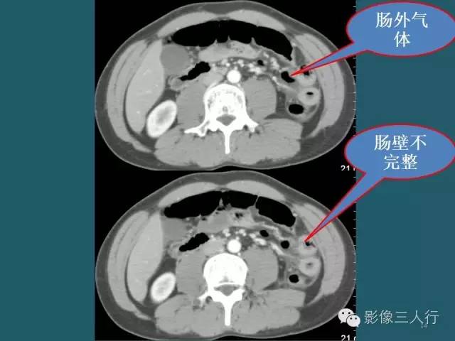 【PPT】肠管与肠系膜损伤的CT诊断