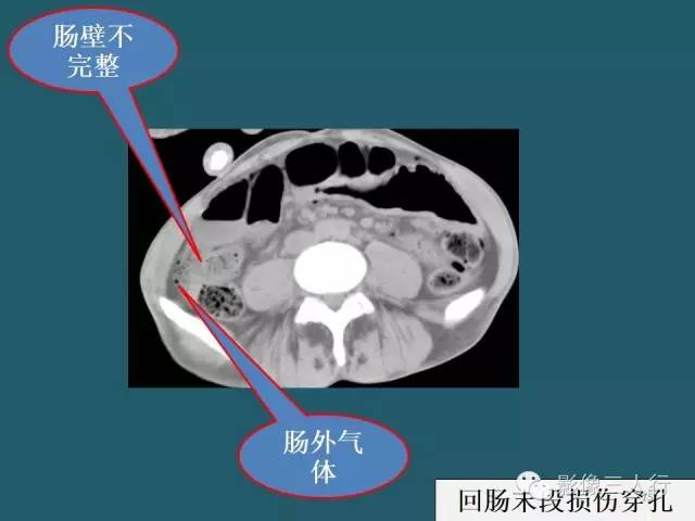 【PPT】肠管与肠系膜损伤的CT诊断