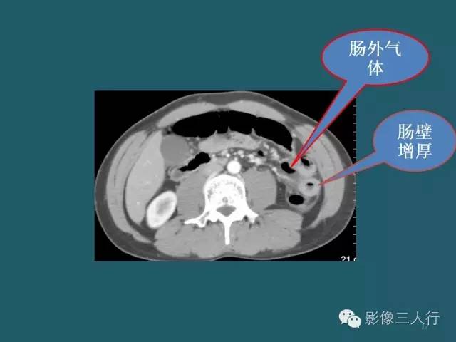 【PPT】肠管与肠系膜损伤的CT诊断