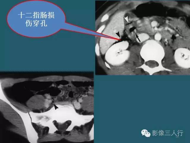 【PPT】肠管与肠系膜损伤的CT诊断