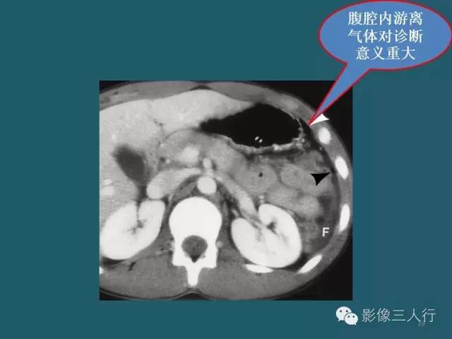 【PPT】肠管与肠系膜损伤的CT诊断